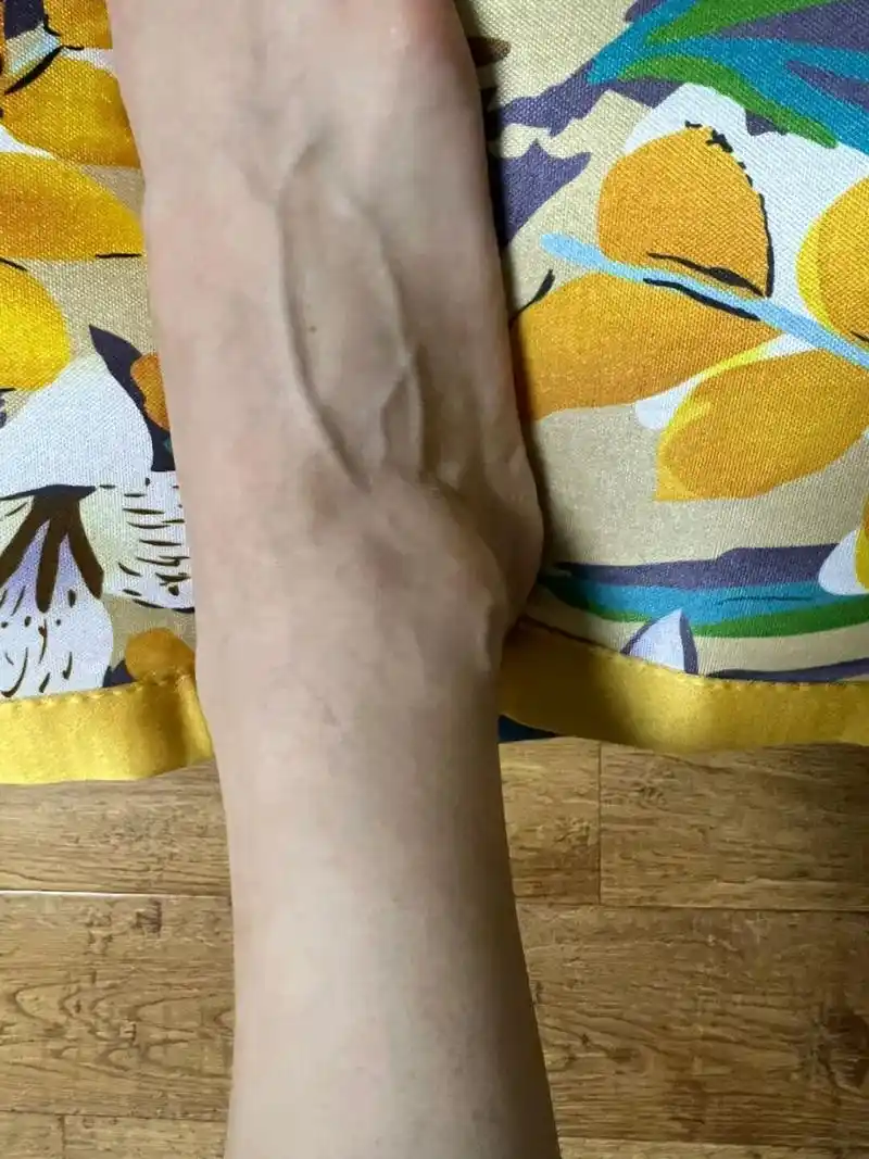 暑期晒得像个烂桃 #佳菲的日常# #晒脚# #青筋# #脚青筋