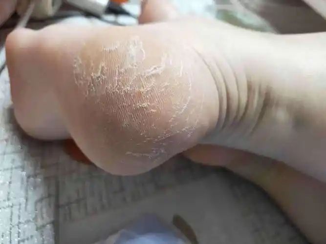 脚后跟老起硬皮,干裂,怎么办啊?