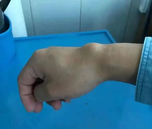 手腕疼还鼓个包当心得了腱鞘囊肿这套护手操送给你