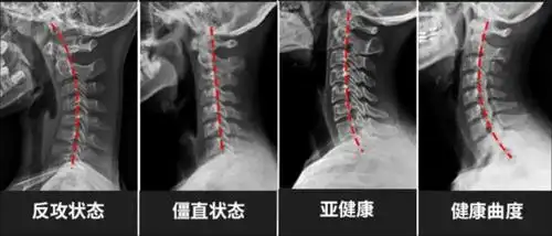 因为人们工作和娱乐等因素,一天大部分时间颈椎曲度实际上是