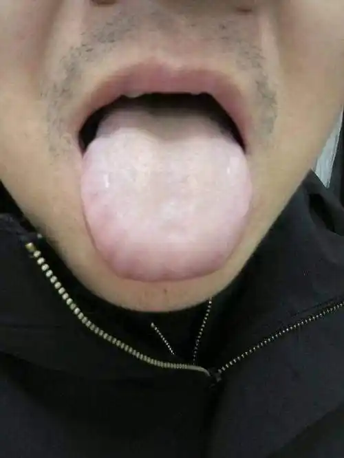 舌边舌尖由淡红变红,而且舌边有齿印——病情加重,提示消化不良,胃肠