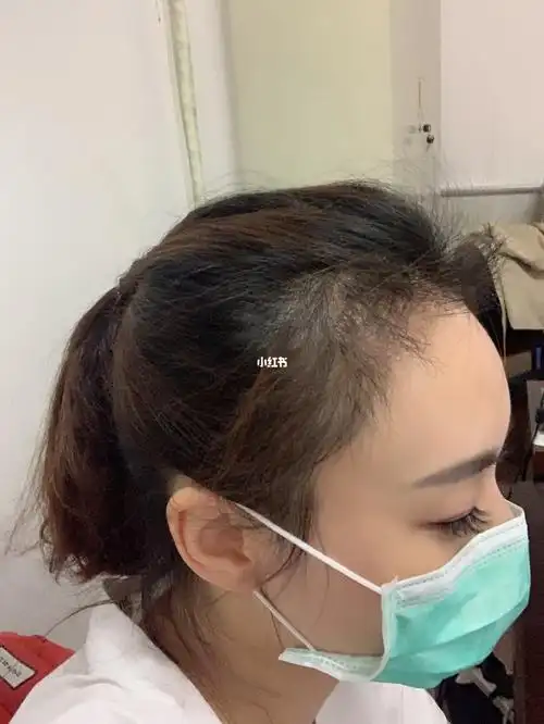 植发三个月了有点炸毛