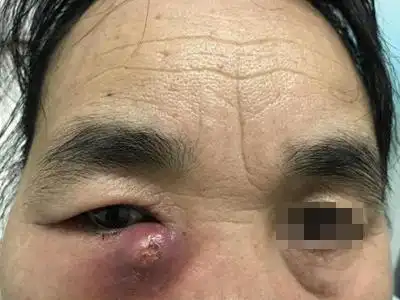 急性泪囊炎的症状和图片 - 有来医生