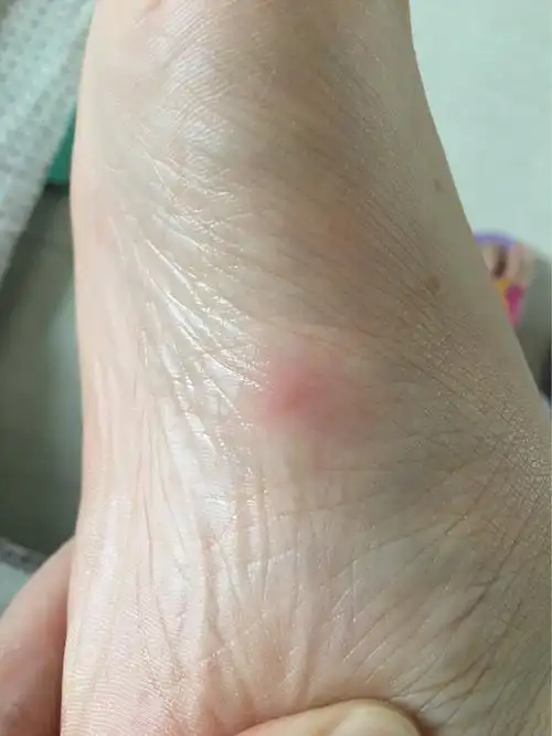 脚心被蚊子叮个包的感觉大家知道吗奇痒无比主要是这个位置还不太好挠