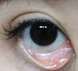 下眼睑有个地方很痒,微肿,会是什么情况?附图