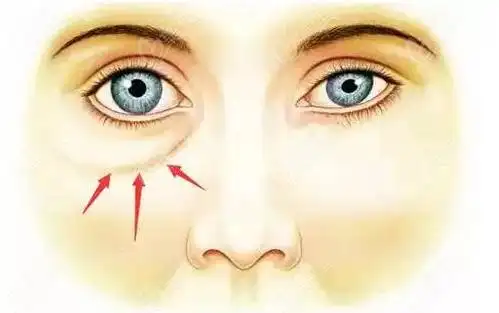 泪沟示意图(m.236z.com)