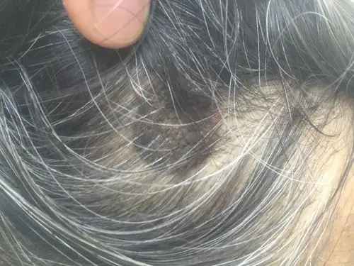 我妈妈头皮上长了一块类似痣一样的东西,表面粗糙,妈妈不肯去看.请
