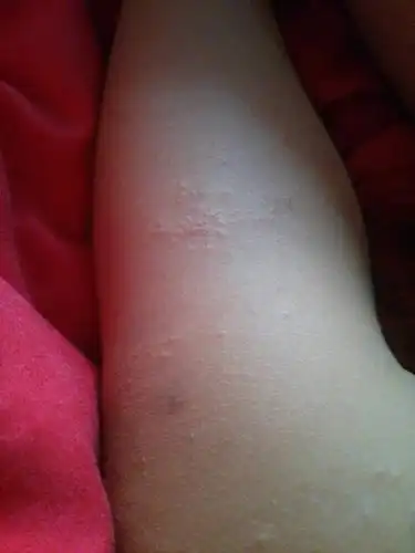 宝宝腿上出了些小疙瘩,有四五天了,不痛不痒的,就是变多了,请问这是