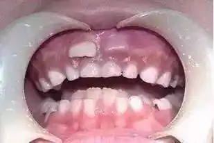 宝宝_牙齿_乳牙