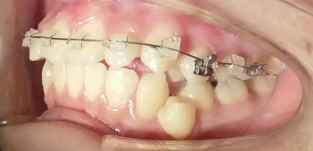 2017年10月1日,三百山李小龙口腔诊所,开始透明陶瓷槽托牙齿矫正