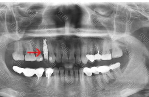 我在长春欣雅花1万6做的诺贝尔种植牙后2年的感受