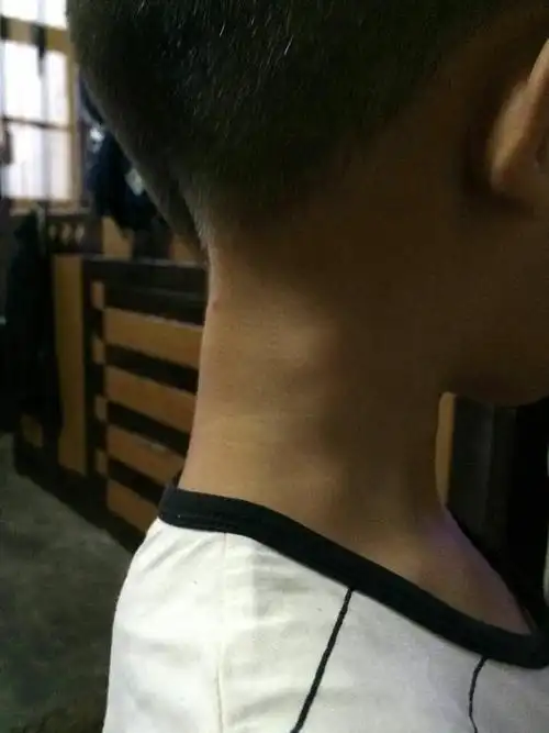 颈部有个包,这是什么情况,怎么办,现在我在家
