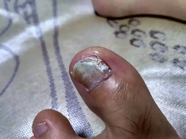 脚趾甲空了,咋回事?这样2年了,以前有过脚气