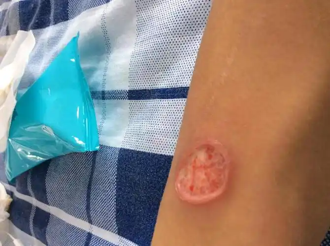 真实烟疤图片,烫烟疤有什么意义?