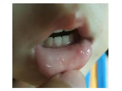 宝宝口腔溃疡图片 (32)