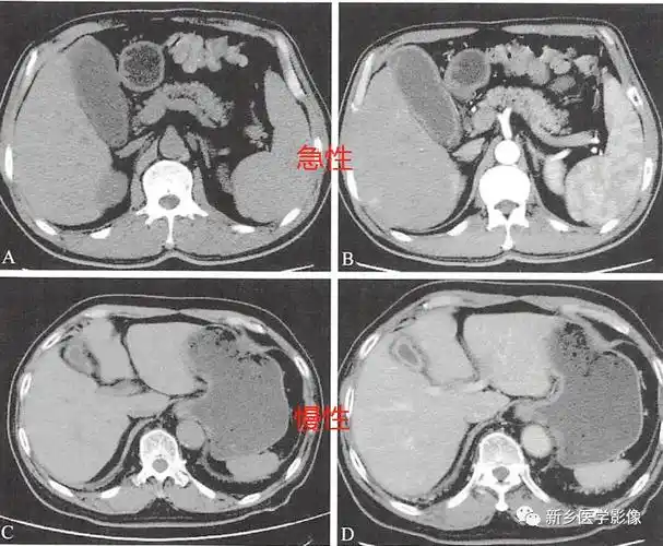读书笔记胆囊炎胆囊息肉胆道结石ct分析