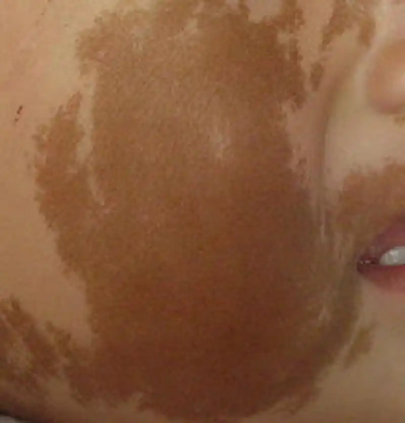 咖啡斑患者  因为胎记患者体内存在的异常黑色素细胞,而正常人体没有