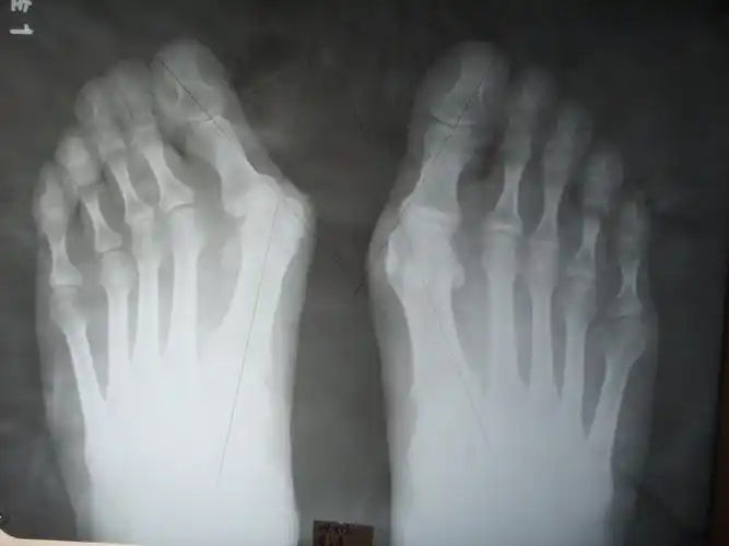 江西南昌大脚骨手术案例做完当天就能回家又好看又快