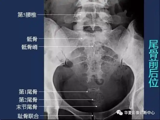 x线解剖图谱尾骨