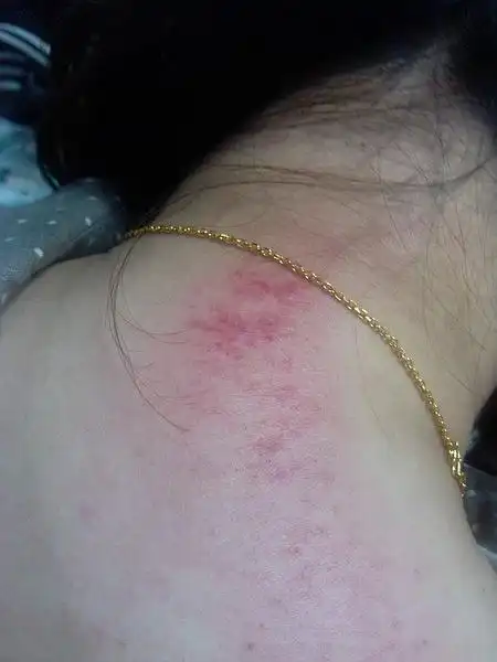 刮痧.上班上的手抽筋,颈椎病犯了