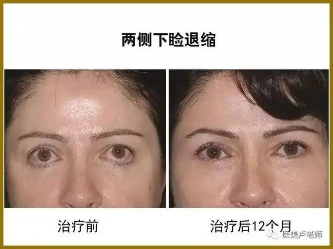 下睑退缩的矫正_眼睑