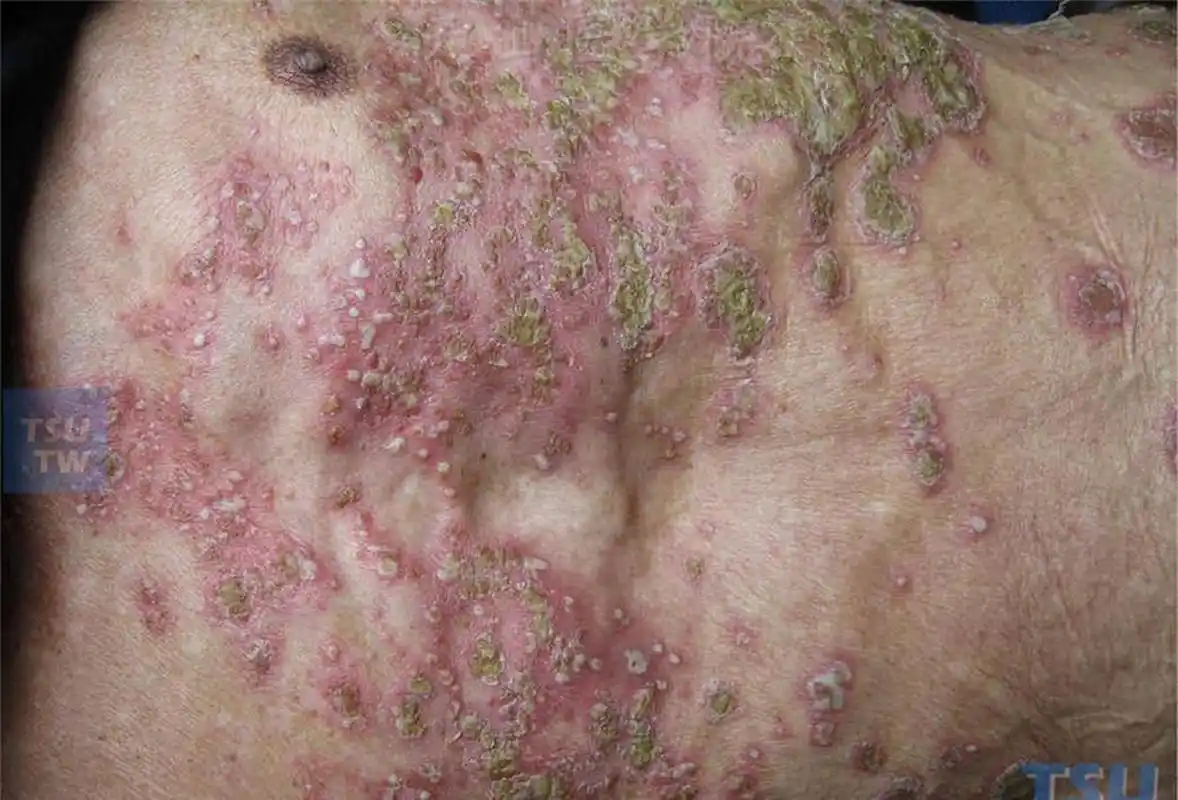 脓疱型银屑病:一般可分为泛发性或掌趾脓疱型银屑病两种.