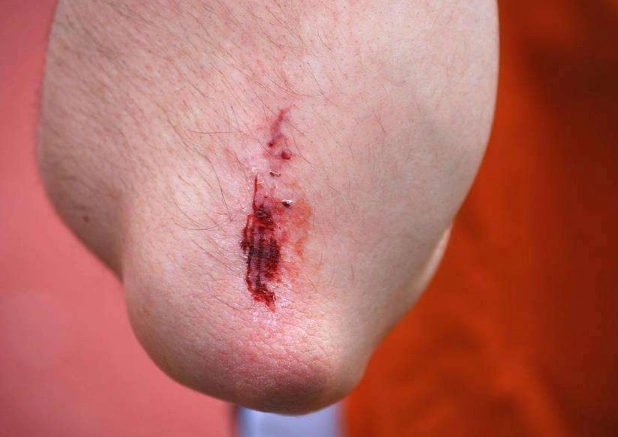 胳膊流血真实图片53