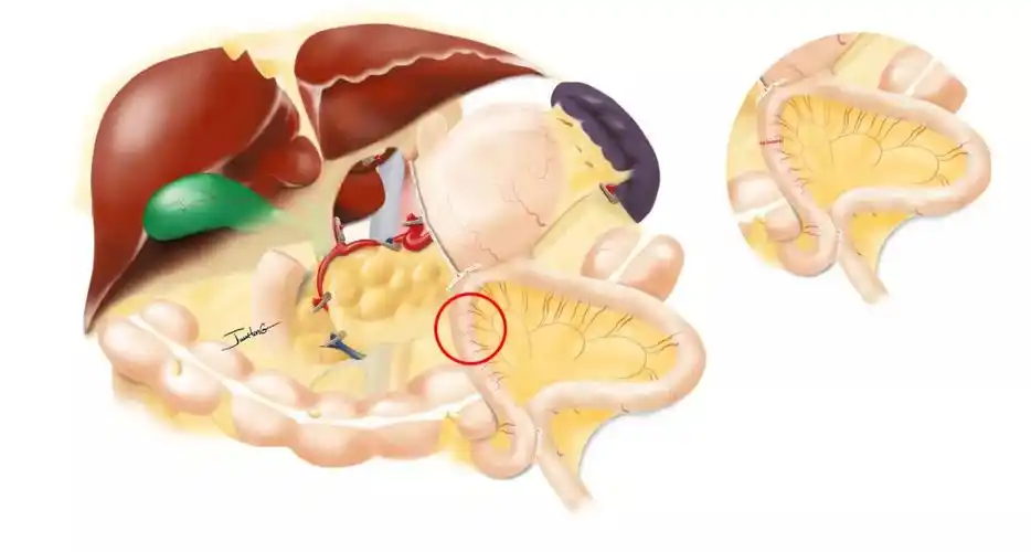 全腹腔镜远端胃切除吻合术uncutroux-en-y吻合_医学界-助力医生临床