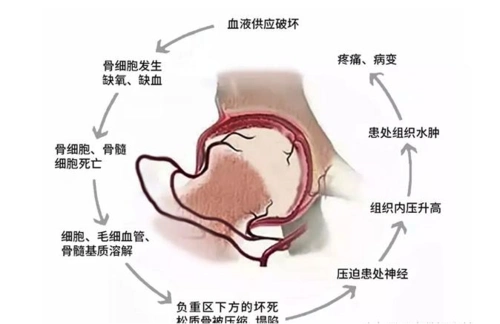 股骨头坏死的原因,股骨头坏死的临床症状表现为髋关节疼痛及活动受限