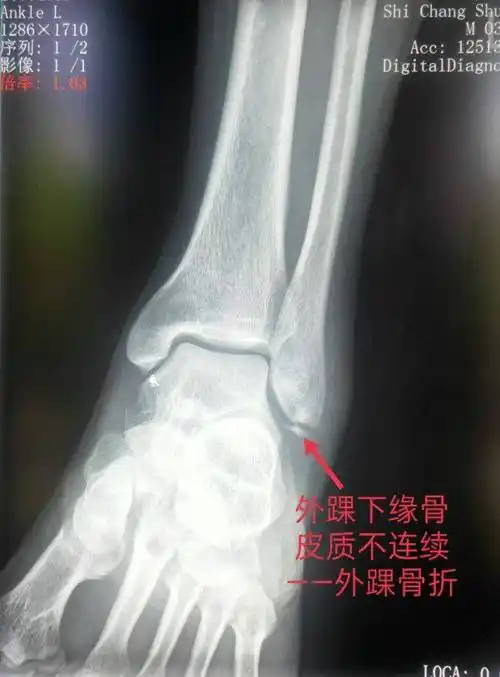 踝关节部位的骨折,脱位x线片踝关节侧位片可以看到胫骨远端,腓骨远端
