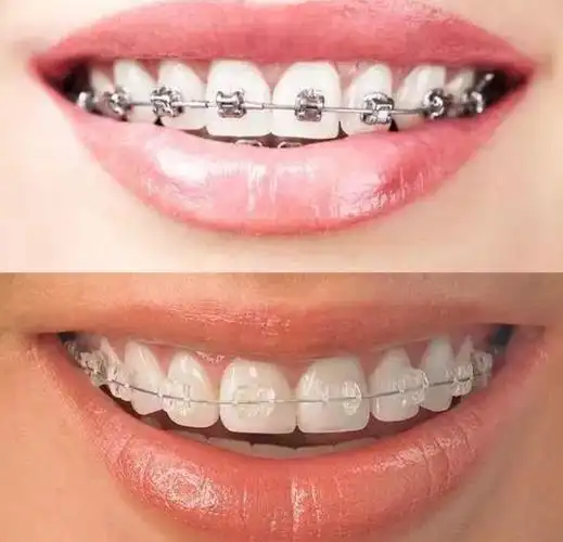 整牙的过程是怎样的干货满满建议收藏