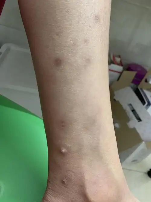 皮肤上有黑色素,然后有小硬块,谁知道是啥,近两.