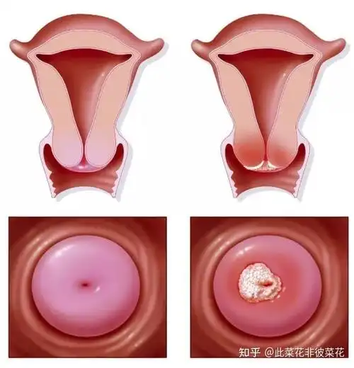 hpv到来,皮肤先知!医生:注意身体预警信号,定期筛查hpv