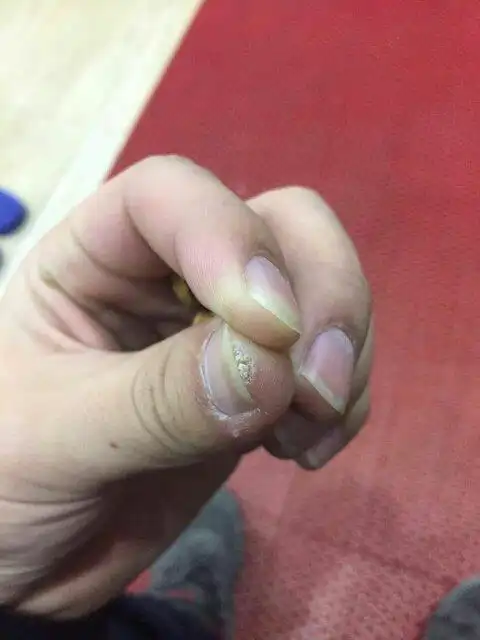 手指尖.之前有硬物刺进去.(大概时间3个月左右前).之后就这样了.