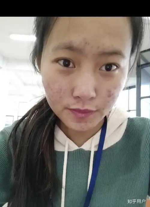 女生脸上毛孔粗大,有黑头,痘痘,怎么护肤?