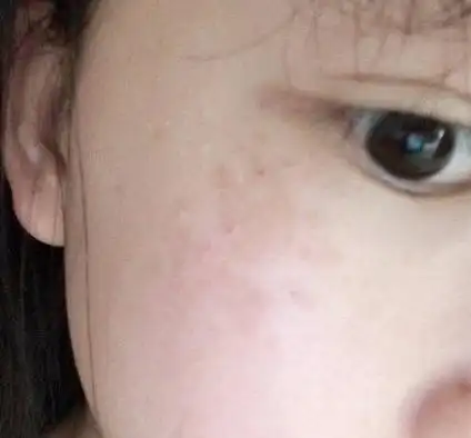 脸部颧骨的斑点能淡化吗