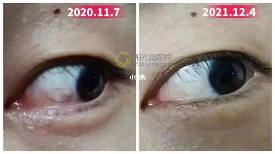 16615年时间眼睛实现了逆生长那个不看好眼罩的男子,睑裂斑,胬肉