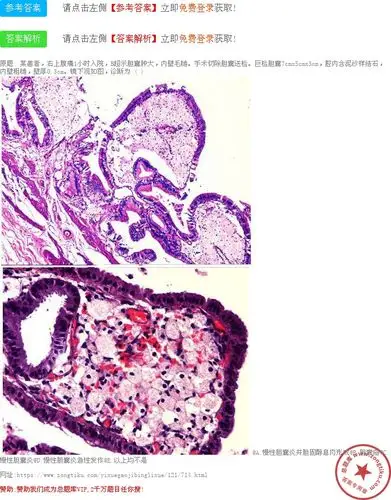 慢性胆囊炎并胆固醇息肉形成 b.胆囊癌 c.慢性胆囊炎 d.