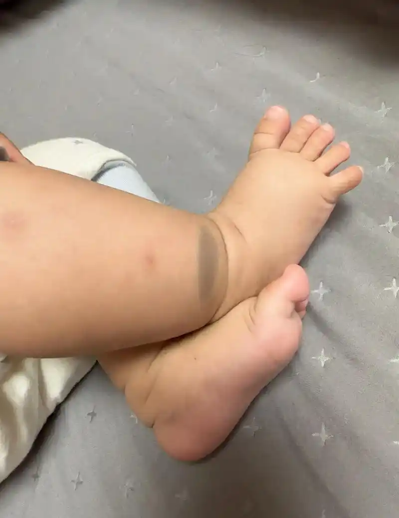 宝宝出生的时候就发现脚踝处有青色印记,这时就突然想起了一个以