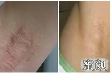 直观感受植皮优势!