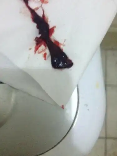 并且还有半透明的东西好似一两肉那么大,但月经来的话一般无以上症状