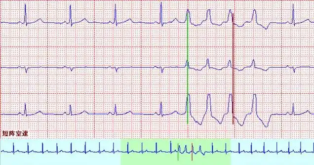上图上宽大畸形qrs前无p波,故诊断短阵室速,若有p波(或与前的t波融合