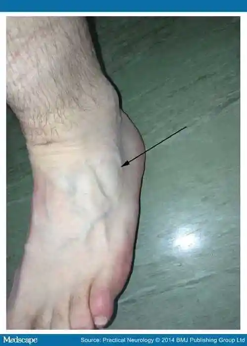 包涵体肌炎患者可引起足下垂,因股四头肌的无力,萎缩常为不对称性