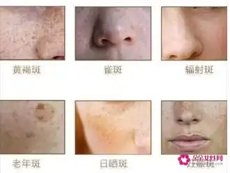 黄褐斑与晒斑的区别『晒斑和黄褐斑的区别在哪里』