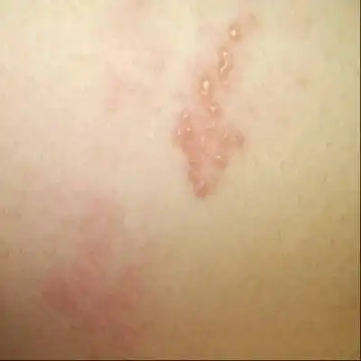 左边乳房下面和背上长这个是什麼原因,还有刺痛