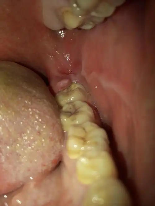 智齿牙后面长了一小块肉,这是怎么回事啊?