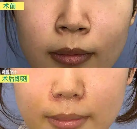 鼻翼缩小内切拆线后别人能看出来吗
