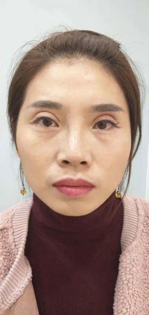 双眼皮的宽与窄