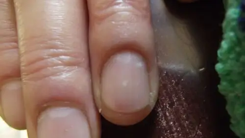 我妈妈指甲里长这种白点是怎么一回事?
