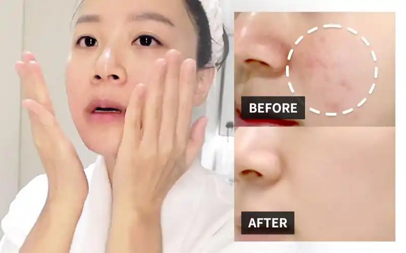 痘痘肌看过来!专业皮肤科医生教你在家享受美容院级别的护理!